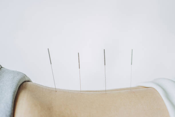 Acupuncture 